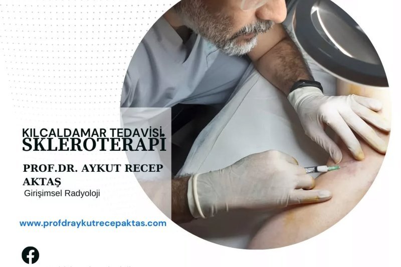 Ameliyatsız Lazerle Varis Tedavisi (EVLA) Uygulama ve İyileşme Süreci - Prof. Dr. Aykut Recep Aktaş